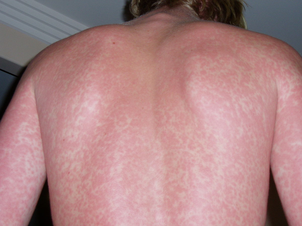 Drug rash