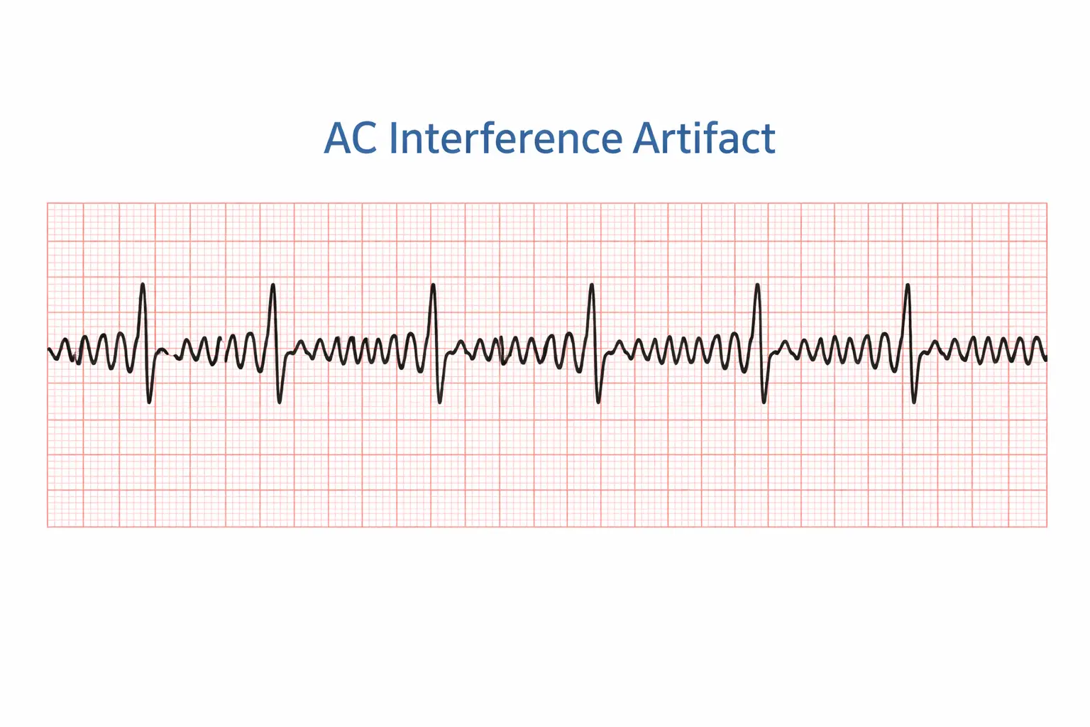 EKG tracing showing AC interference artifact