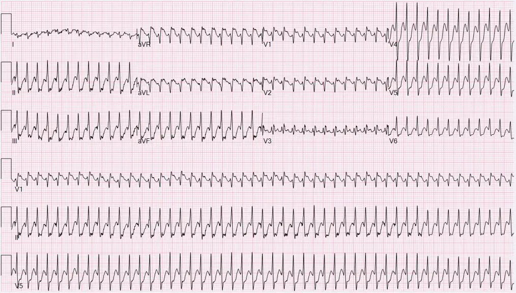 EKG tracing showing atrial flutter rhythm