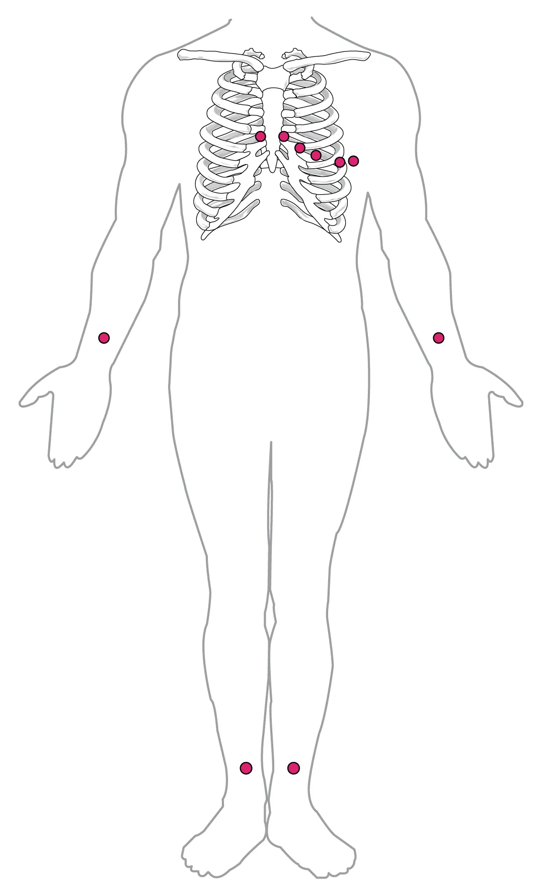 Placement of bipolar and standard EKG leads shown