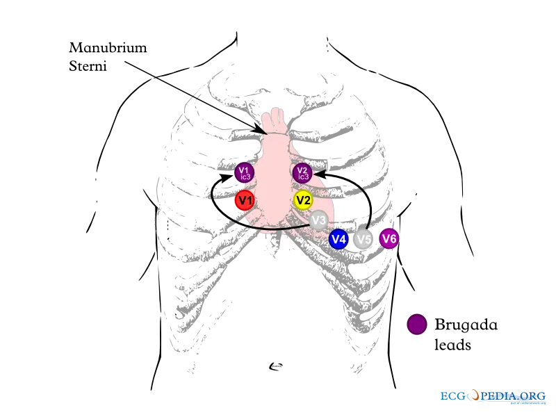 Chest lead placement at intercostal spaces shown
