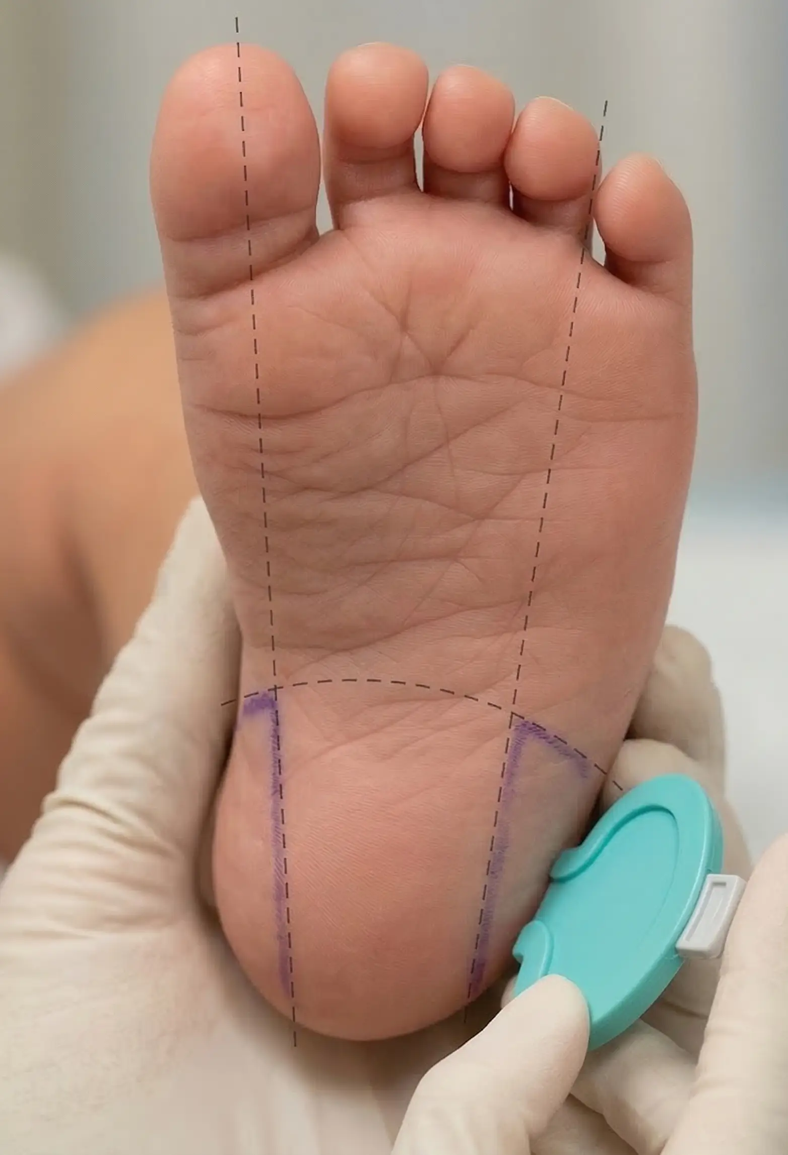 Correct heel stick lancet placement for an infant shown