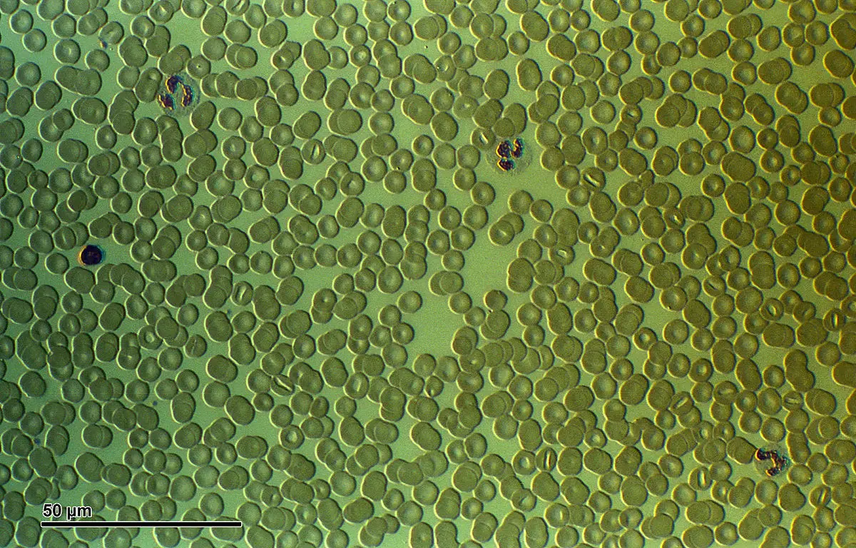 Differential blood smear showing various blood cell types
