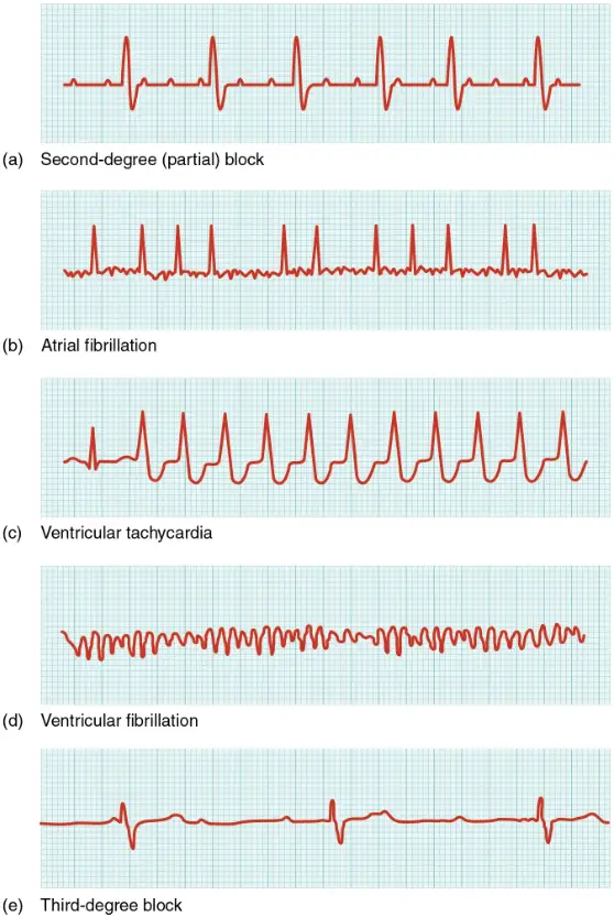 EKG tracings showing common ECG abnormalities