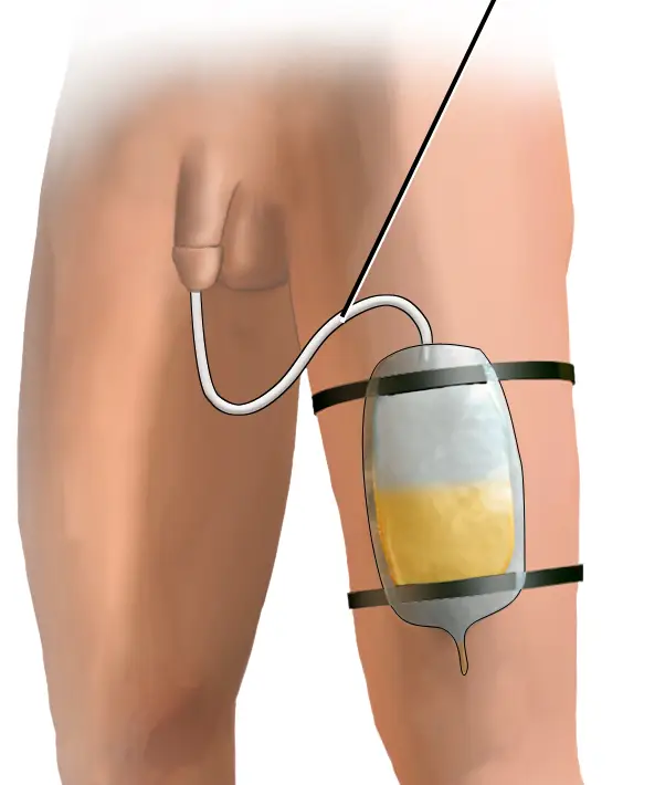 Foley catheter with drainage bag displayed