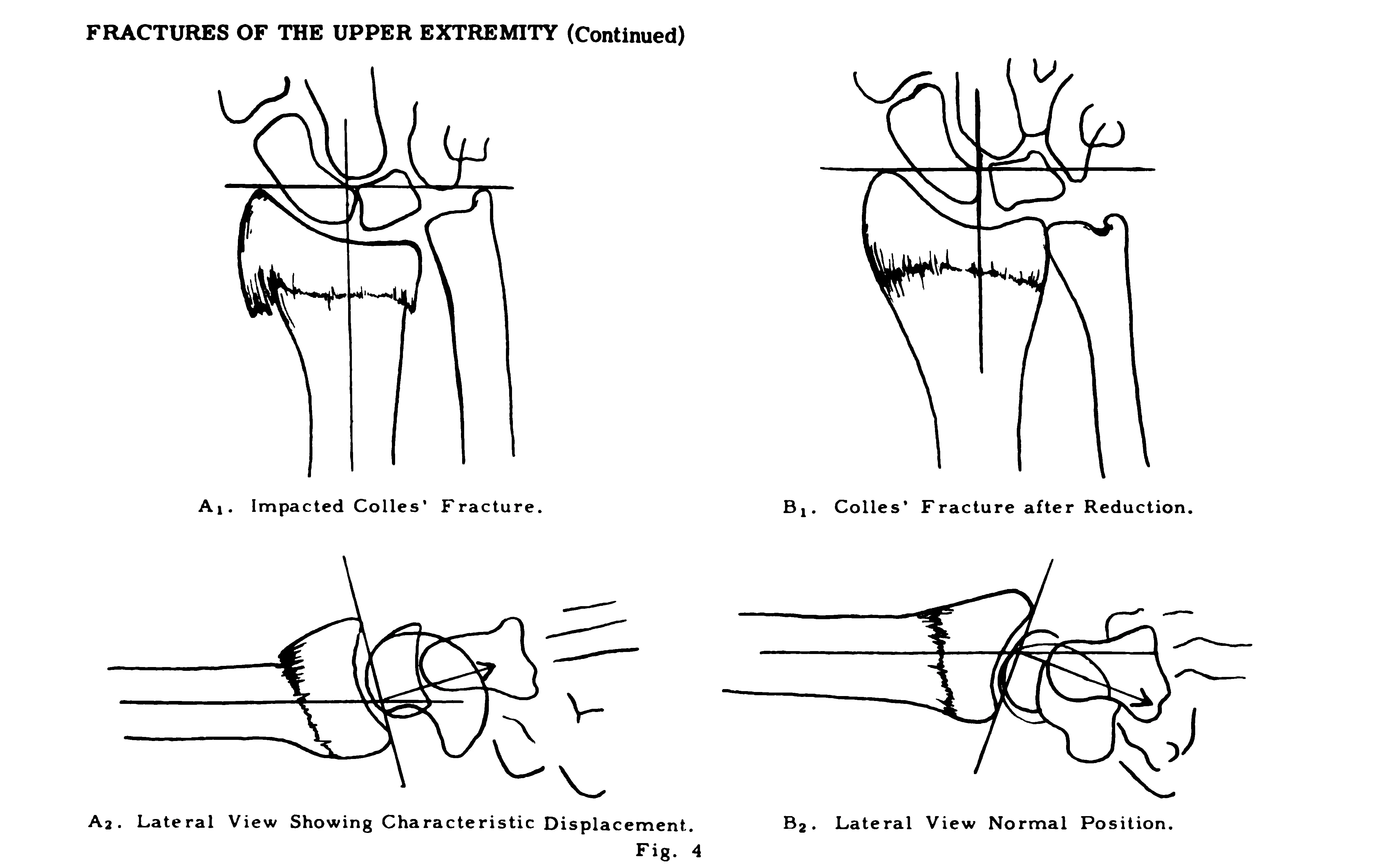 Four diagrams showing Colles’ fracture and wrist alignment before and after reduction.