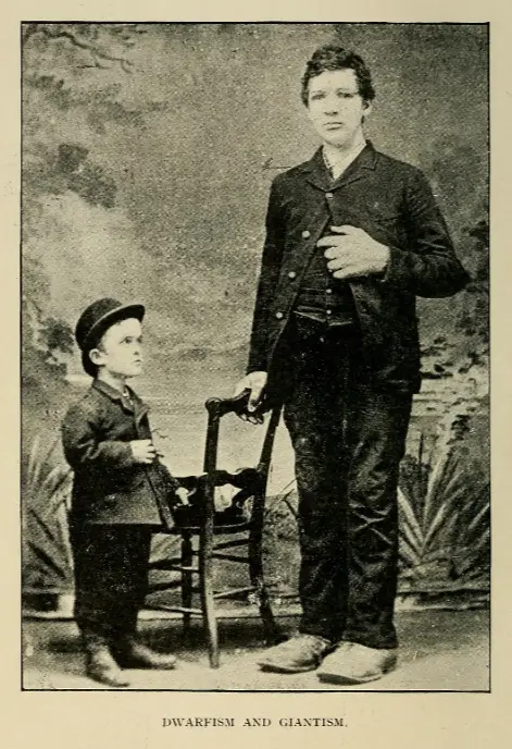 Gigantism and dwarfism compared due to growth hormone disorders