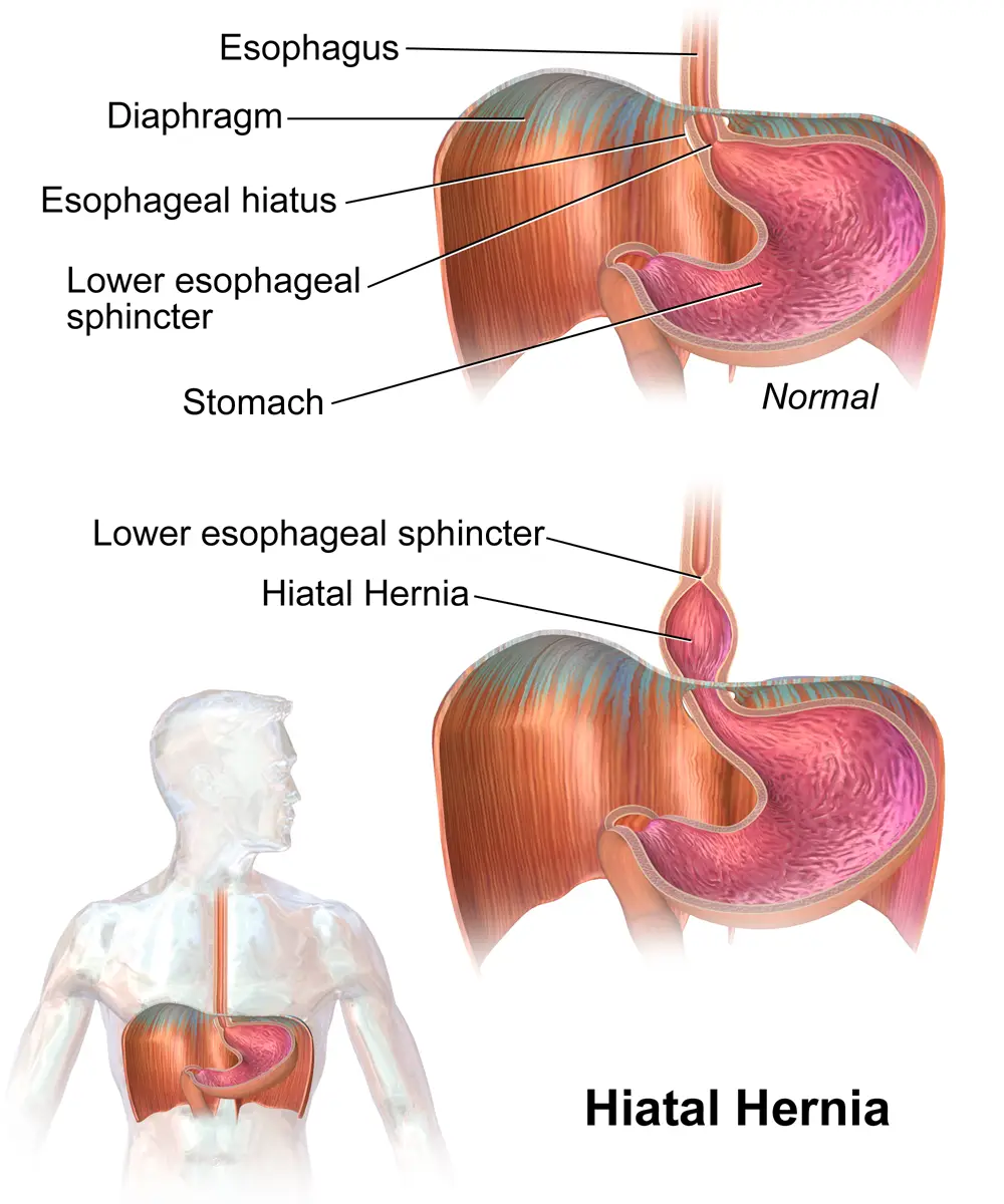 Hiatal hernia and its effect on the stomach shown