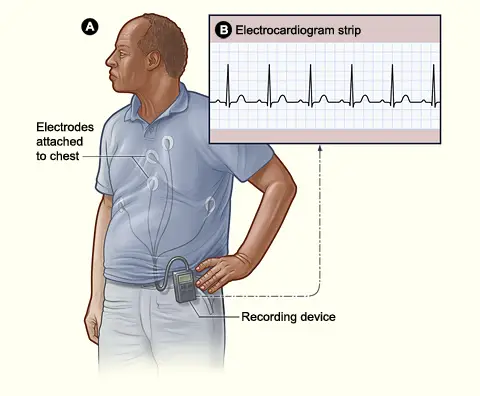Holter monitor used for extended cardiac monitoring