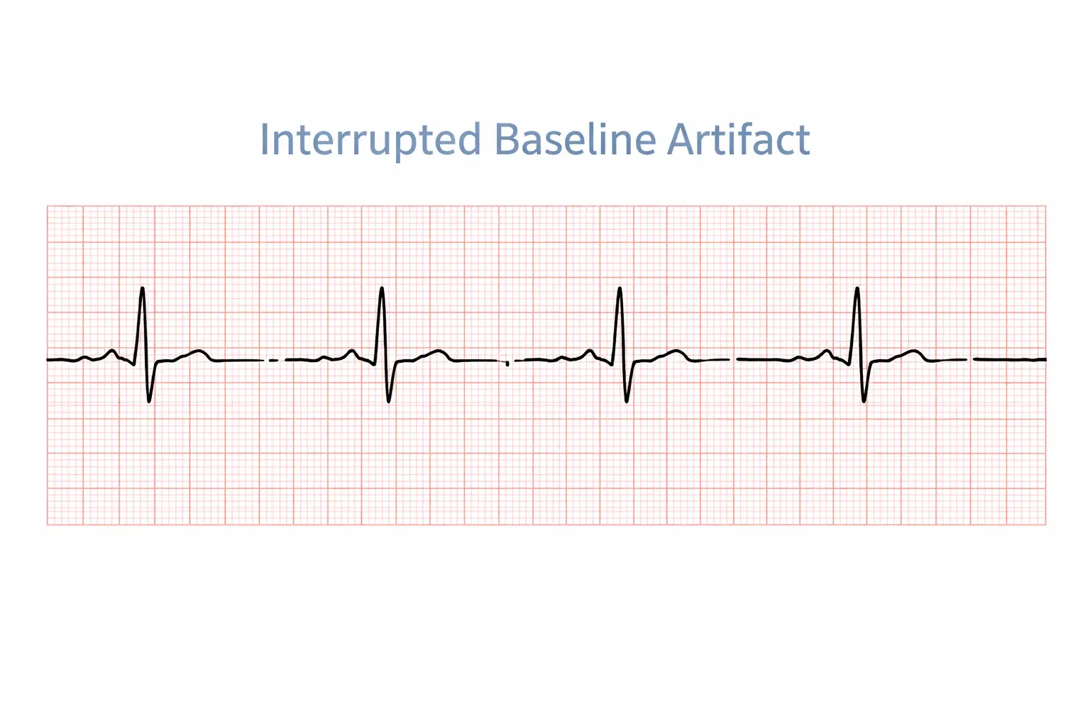 EKG tracing showing interrupted baseline artifact