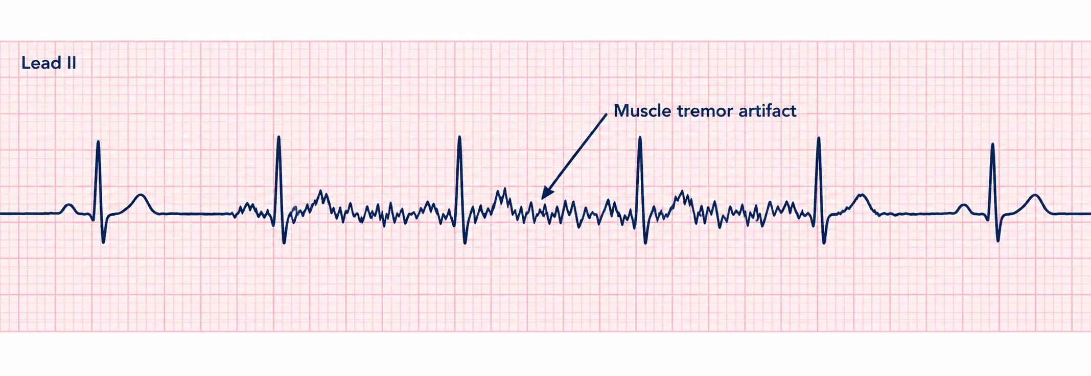 Lead II ECG strip showing regular QRS complexes and P waves, but the baseline between beats is coarse and jagged rather than flat, labeled as muscle tremor artifact obscuring the underlying signal.