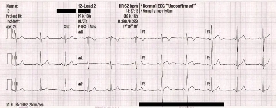 EKG tracing showing normal sinus rhythm