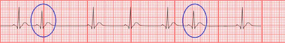 EKG tracing showing premature atrial contractions (PACs)