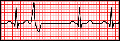 EKG tracing showing premature ventricular contractions (PVCs)