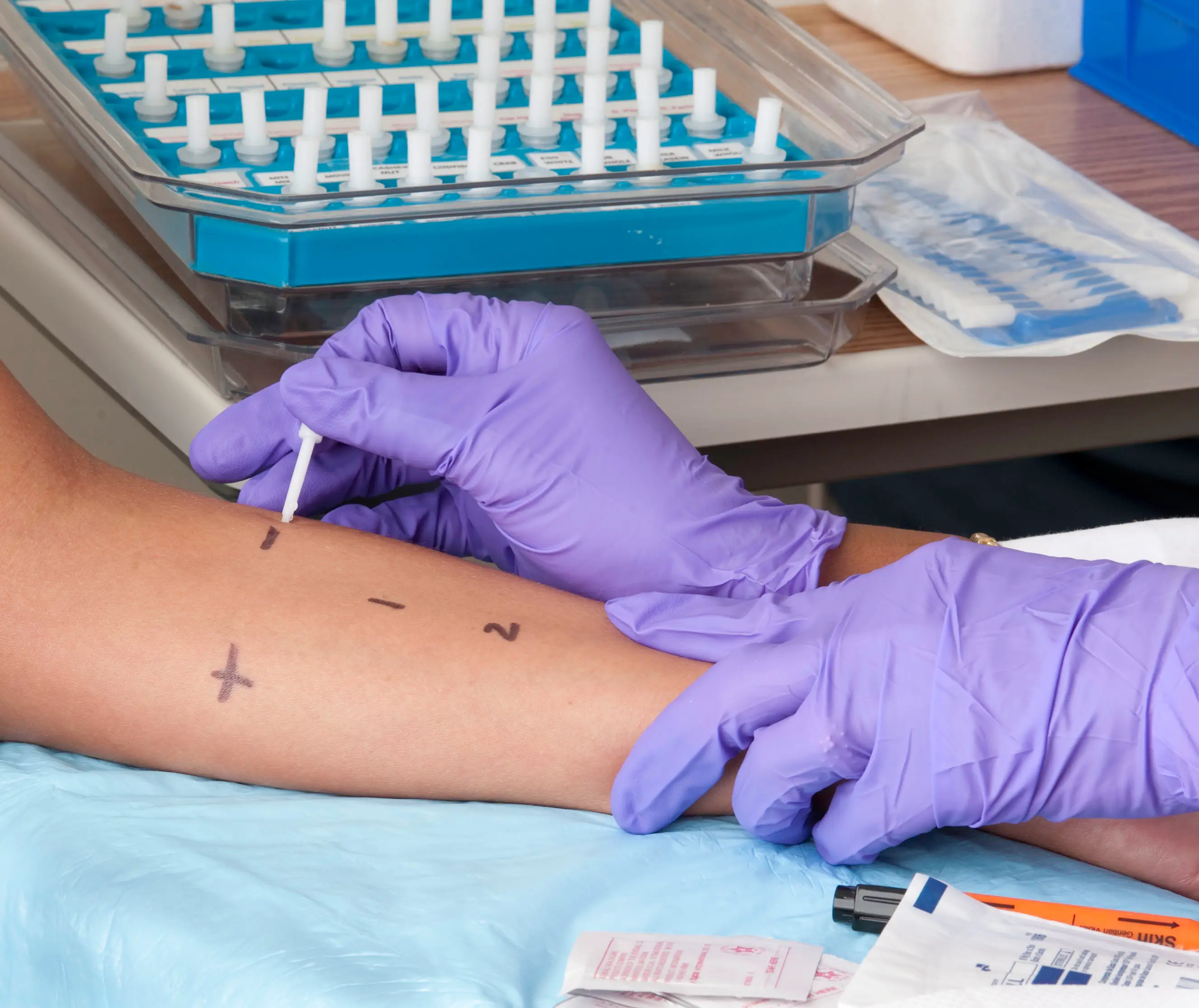 Skin allergy testing sites and result interpretation shown