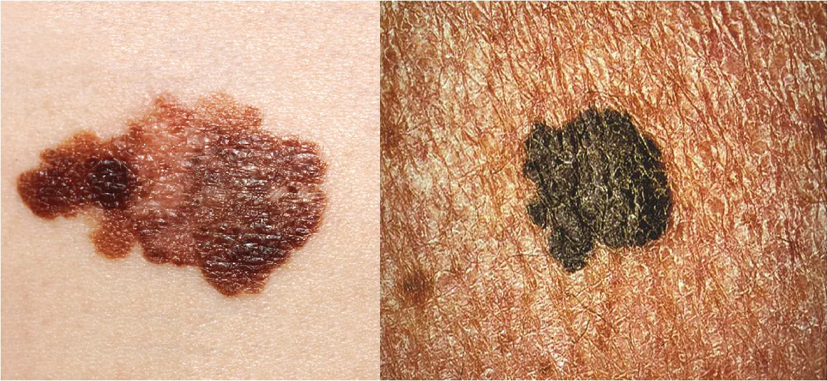 Various types of skin lesions and their characteristics shown