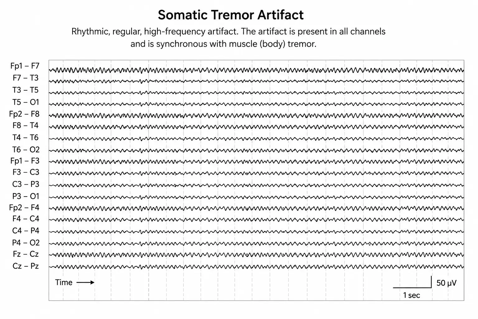 EEG showing somatic tremor artifact across multiple channels.