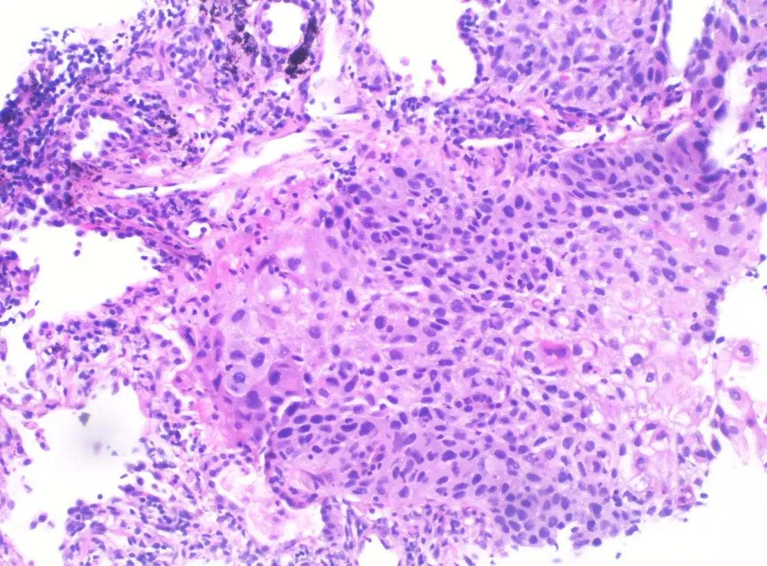 Squamous cell carcinoma present on the skin