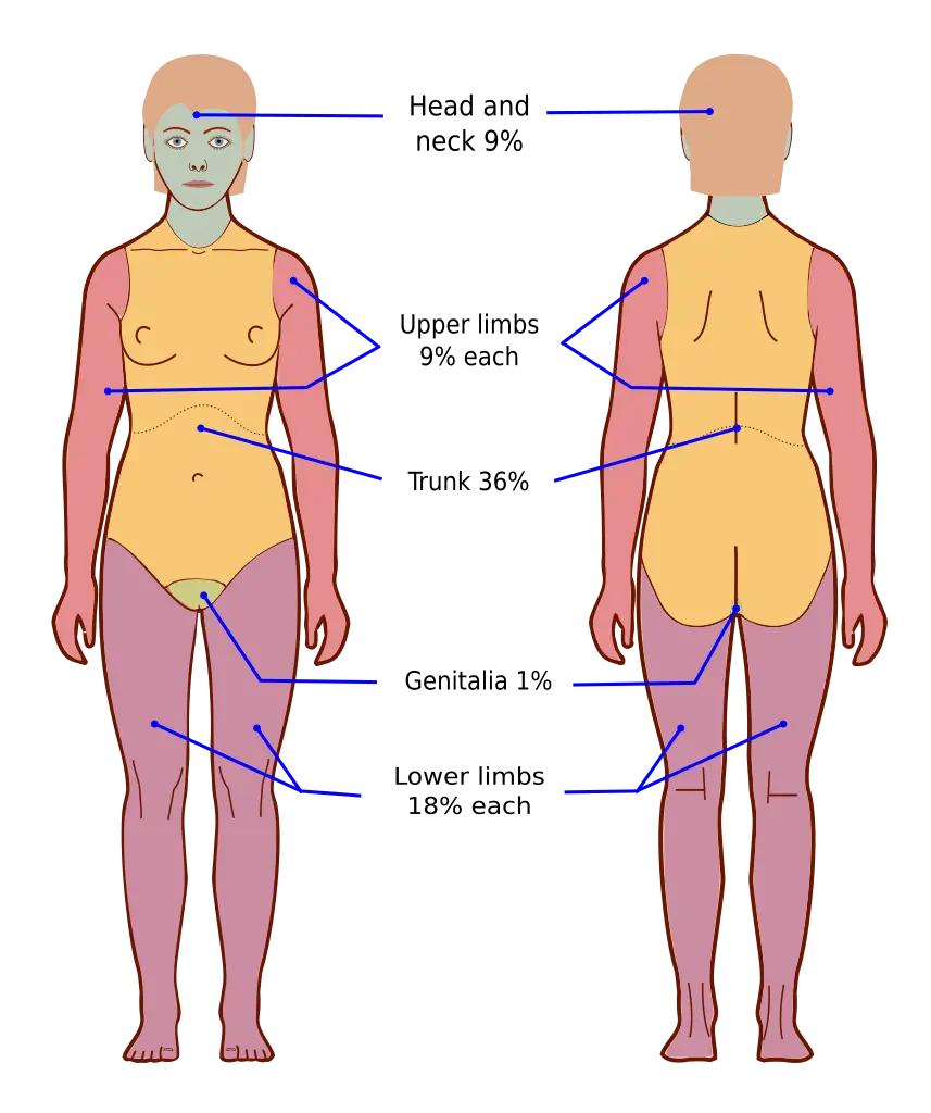 Rule of nines for estimating burn area on the body shown