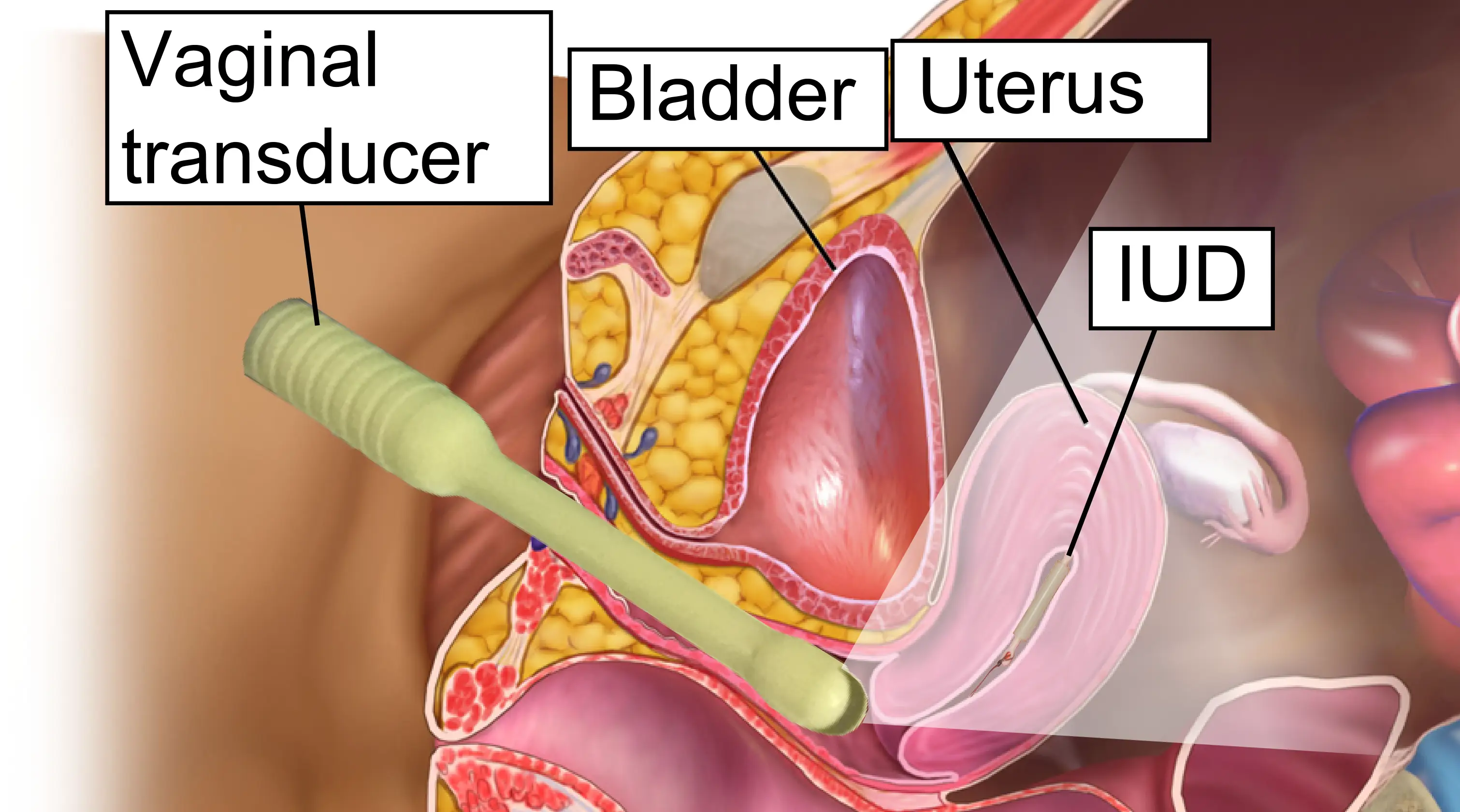 Uterus with an intrauterine device (IUD) in place