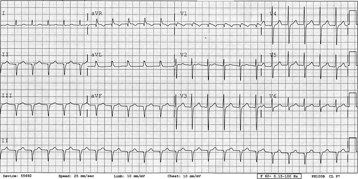 EKG tracing showing wandering baseline artifact