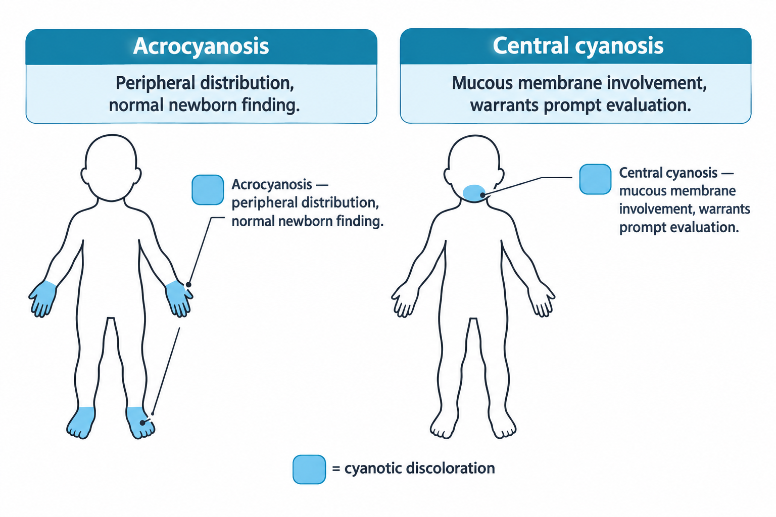 Two labeled newborn body outlines compare cyanosis patterns: the left figure shows blue coloring limited to the hands and feet, labeled acrocyanosis with peripheral distribution as a normal newborn finding; the right figure shows blue coloring around the mouth and lips, labeled central cyanosis with mucous membrane involvement as a finding that warrants prompt evaluation. A legend at the bottom indicates the blue color represents cyanotic discoloration.