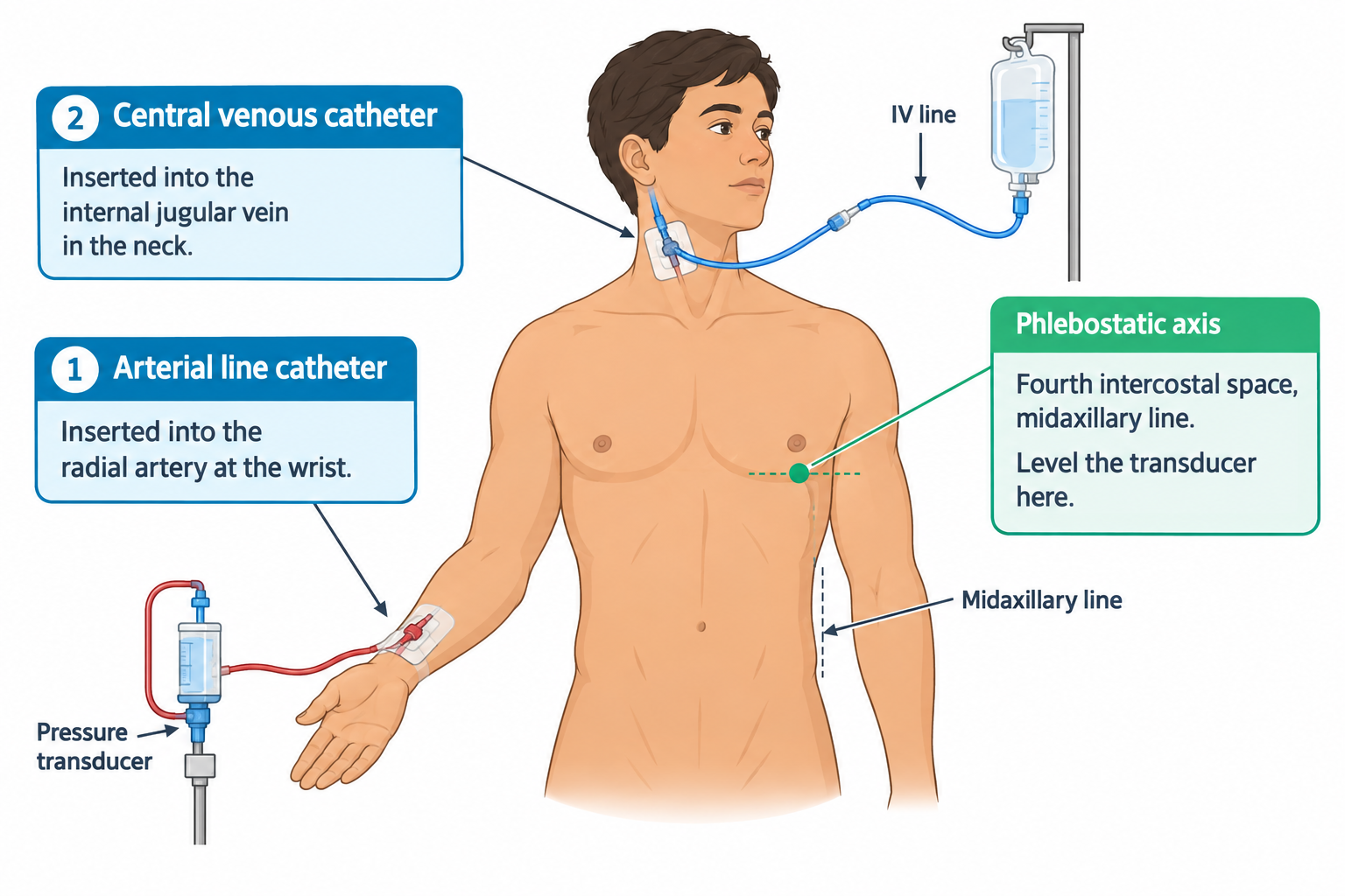 Illustration of a person's upper torso showing two invasive monitoring lines: an arterial line catheter inserted into the radial artery at the wrist, connected via tubing to a pressure transducer, and a central venous catheter inserted into the internal jugular vein in the neck, connected to an IV line and fluid bag. The phlebostatic axis is marked on the chest at the fourth intercostal space, midaxillary line, with a dashed line indicating the midaxillary line landmark for leveling the transducer.