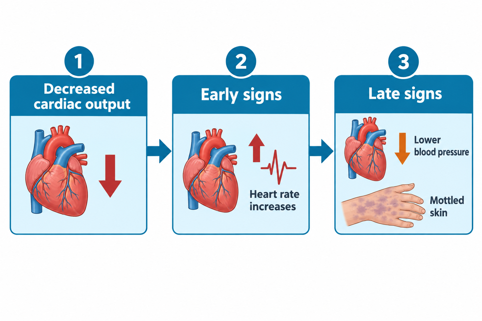 A three-step flow diagram shows a heart with a downward arrow labeled 'Decreased cardiac output,' leading to a heart with an ECG waveform and upward arrow labeled 'Heart rate increases' under 'Early signs,' leading to a heart with a downward arrow labeled 'Lower blood pressure' and an image of a hand with mottled, bruise-like discoloration labeled 'Mottled skin' under 'Late signs.'