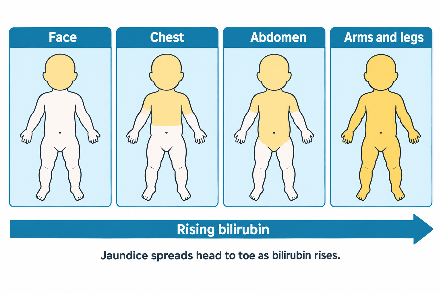 Four side-by-side panels show a newborn's body becoming progressively more yellow to illustrate cephalocaudal jaundice progression: in 'Face,' only the head is yellow-tinted while the body remains pale; in 'Chest,' the head and chest are yellow; in 'Abdomen,' the yellowing extends to include the abdomen; and in 'Arms and legs,' the entire body including the limbs is yellow. A horizontal arrow labeled 'Rising bilirubin' spans below the panels, with a caption noting that jaundice spreads head to toe as bilirubin rises.
