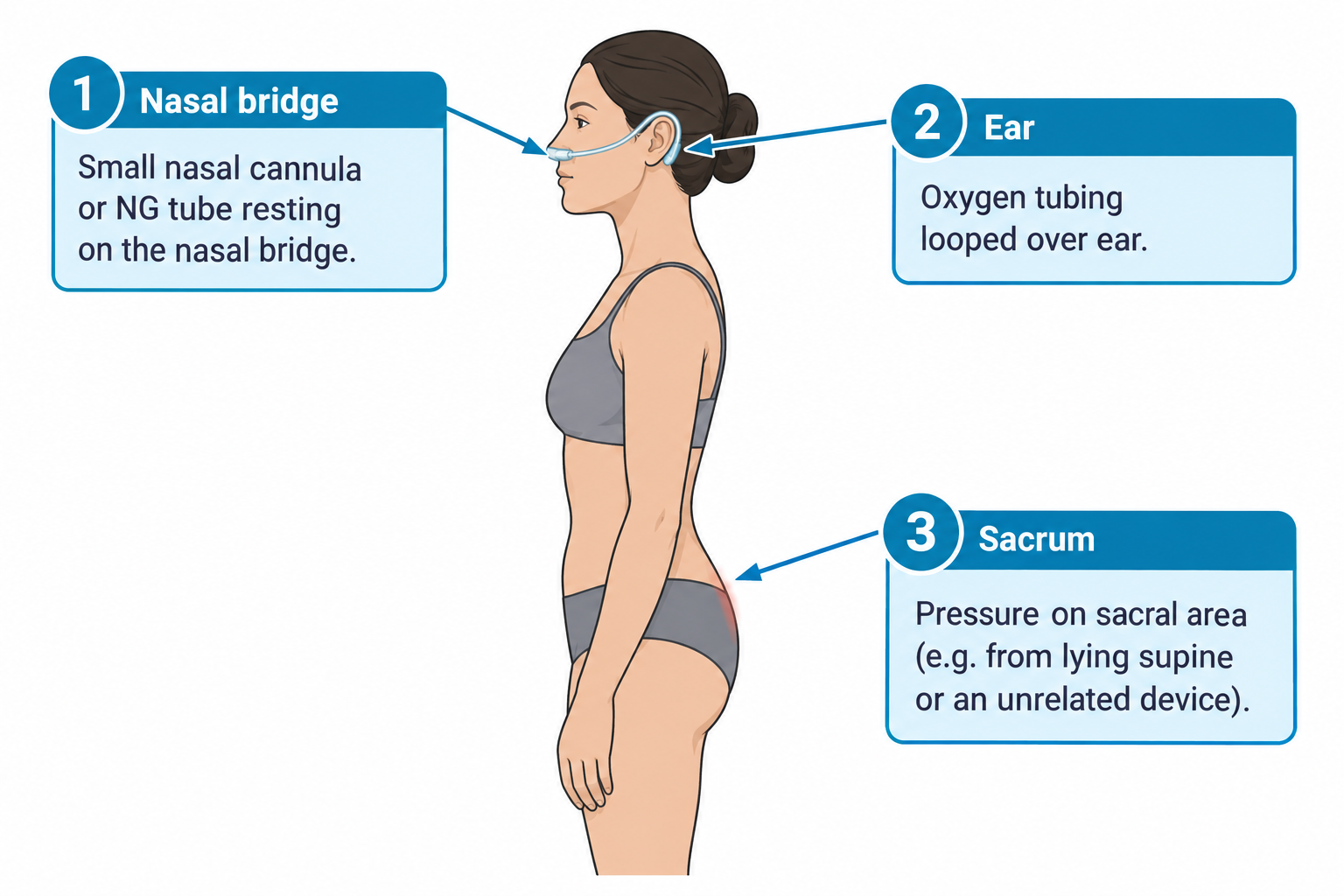 A side-view illustration of a woman with three numbered callouts pointing to common pressure injury sites from medical devices: the nasal bridge showing a nasal cannula resting on the nose, the ear showing oxygen tubing looped over it, and the sacrum showing a small area of redness at the lower back just above the buttocks indicating pressure injury risk.