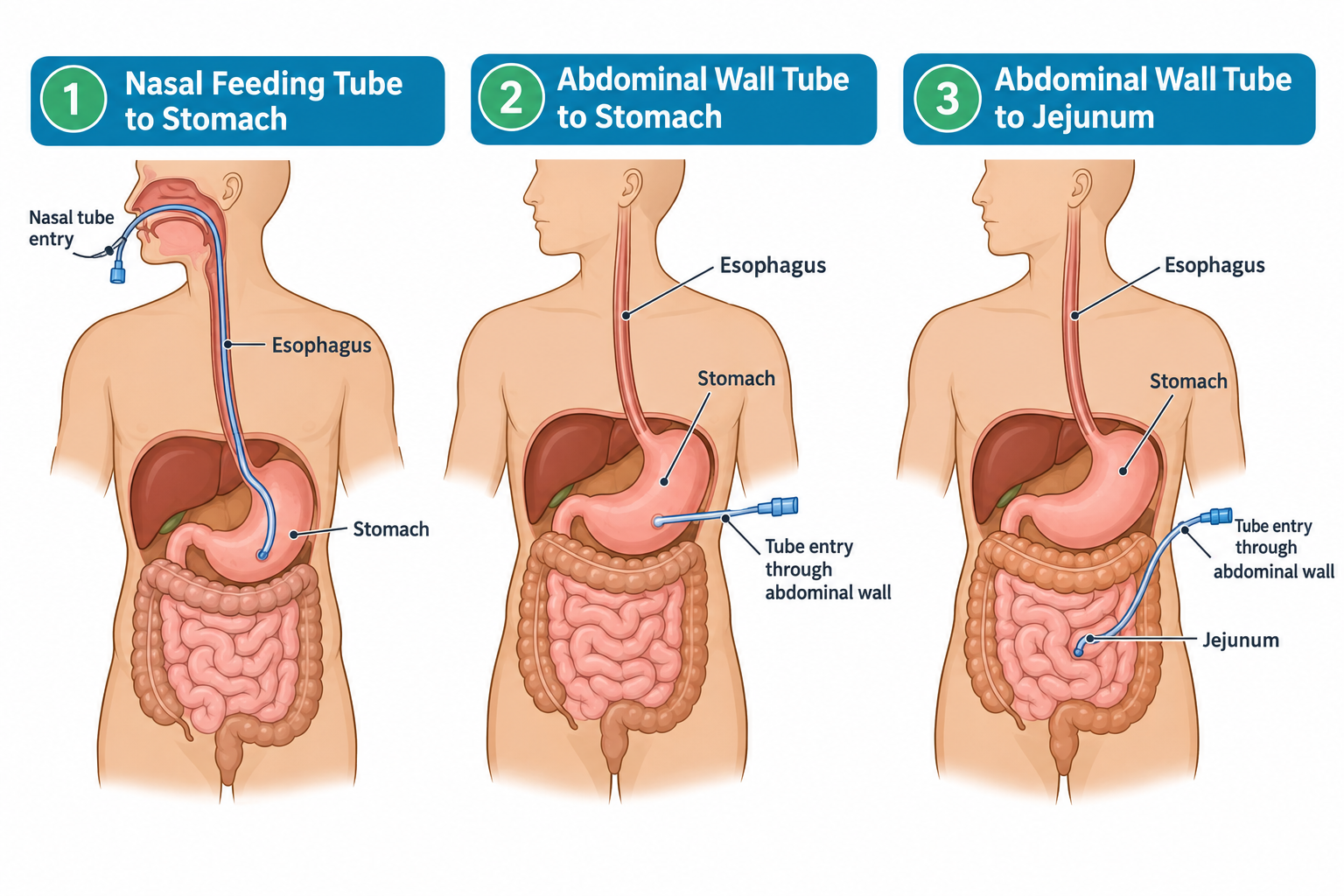 Three cutaway torso diagrams comparing feeding tube placements: an NG tube entering through the nose and passing down the esophagus into the stomach; a PEG-type tube entering directly through the abdominal wall into the stomach; and a jejunostomy tube entering through the abdominal wall and threading into the jejunum, with esophagus, stomach, and jejunum labeled in each panel.
