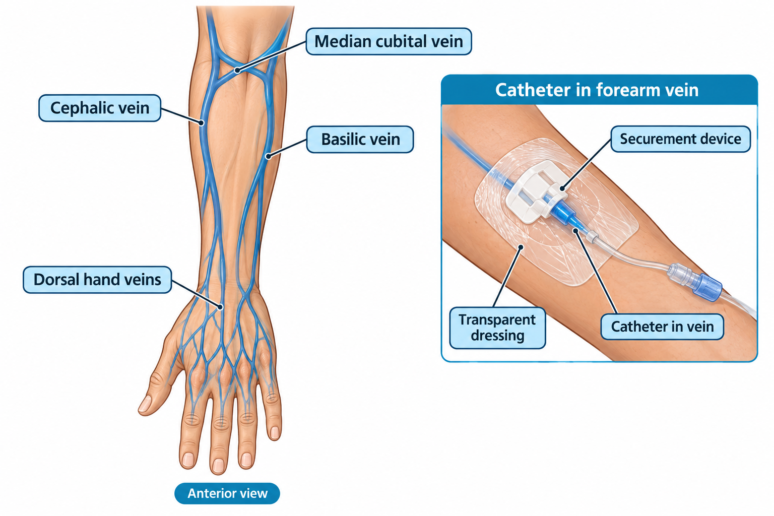 Anterior view of the forearm and hand showing four common peripheral IV sites: the dorsal hand veins, the cephalic vein along the thumb side of the forearm, the basilic vein along the inner side, and the median cubital vein crossing the antecubital fossa. An inset close-up shows a catheter inserted into a forearm vein, covered by a transparent dressing and held in place with a plastic securement device, with IV tubing connected at the hub.