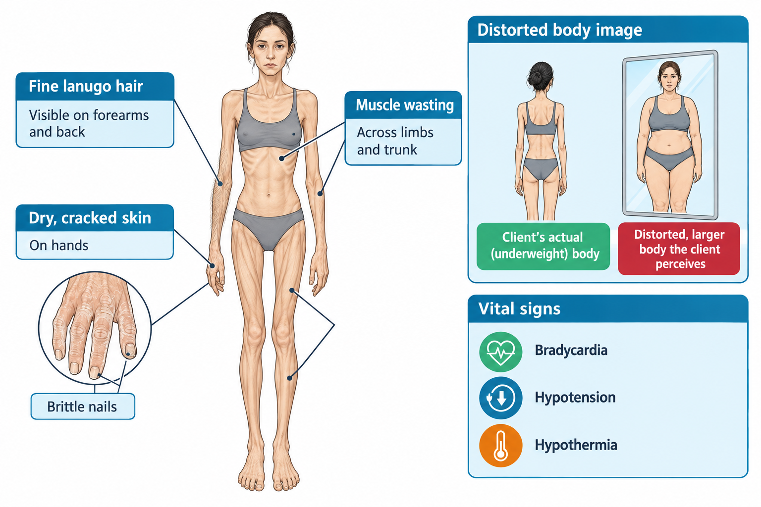 An emaciated young woman is shown from the front with callout labels pointing to fine lanugo hair on the forearms and back, dry cracked skin and brittle nails on the hands, and muscle wasting across the limbs and trunk. Two side panels show a mirror comparison illustrating distorted body image—her actual underweight body versus the larger body she perceives in the mirror—and a vital signs panel listing bradycardia, hypotension, and hypothermia with corresponding icons.