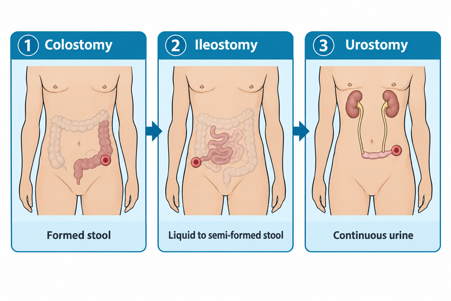 Three labeled body diagrams compare ostomy types: a colostomy showing the large intestine with a stoma on the lower abdomen and 'Formed stool' output; an ileostomy showing the small intestine with a stoma in the lower abdomen and 'Liquid to semi-formed stool' output; and a urostomy showing both kidneys and ureters connected to a short ileal conduit segment ending in a stoma, with 'Continuous urine' output.