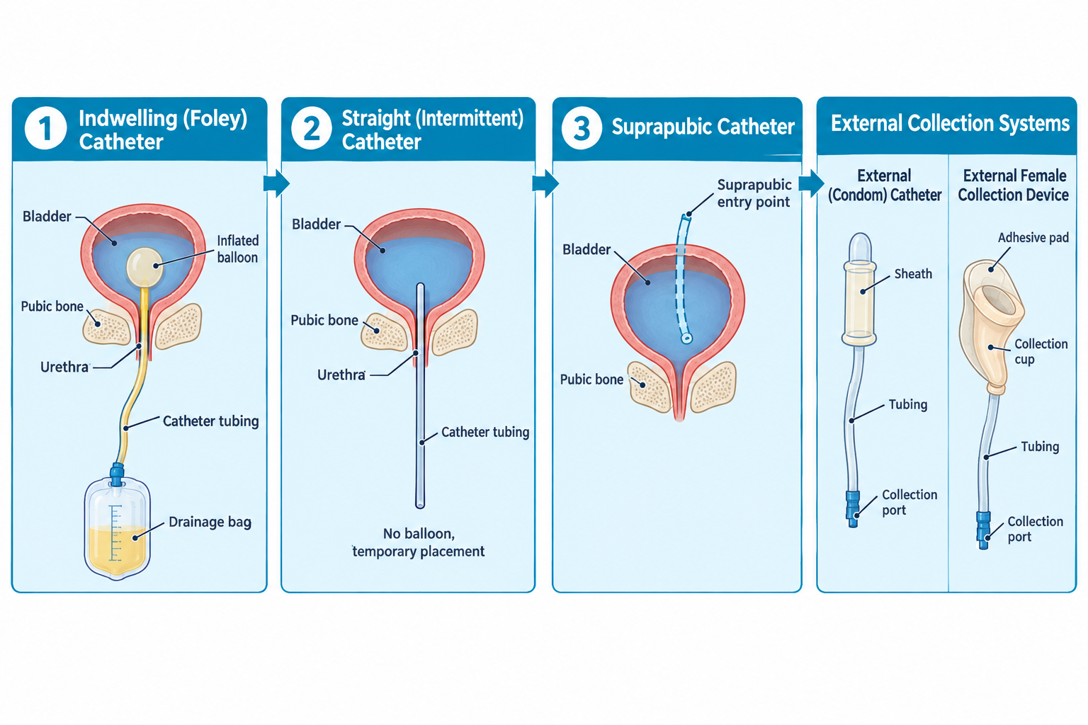 Four-panel diagram of urinary catheter types shown in cross-section of the bladder and pelvis: (1) an indwelling Foley catheter with its balloon inflated inside the bladder, tubing running through the urethra to a drainage bag; (2) a straight intermittent catheter, a tube without a balloon passing through the urethra for temporary placement; (3) a suprapubic catheter entering through the abdominal wall above the pubic bone directly into the bladder; and (4) two external collection systems — a male external (condom) catheter with sheath, tubing, and collection port, and an external female collection device with adhesive pad, collection cup, tubing, and collection port.