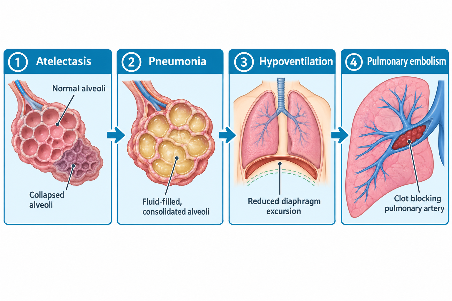 A four-panel comparison illustration: Panel 1 shows atelectasis with normal alveoli next to collapsed, deflated alveoli; Panel 2 shows pneumonia with alveoli filled with yellow fluid and consolidated; Panel 3 shows hypoventilation as a front view of the lungs and diaphragm with dashed lines indicating reduced diaphragm excursion; Panel 4 shows a pulmonary embolism as a dark red clot blocking a branch of the pulmonary artery within lung tissue.