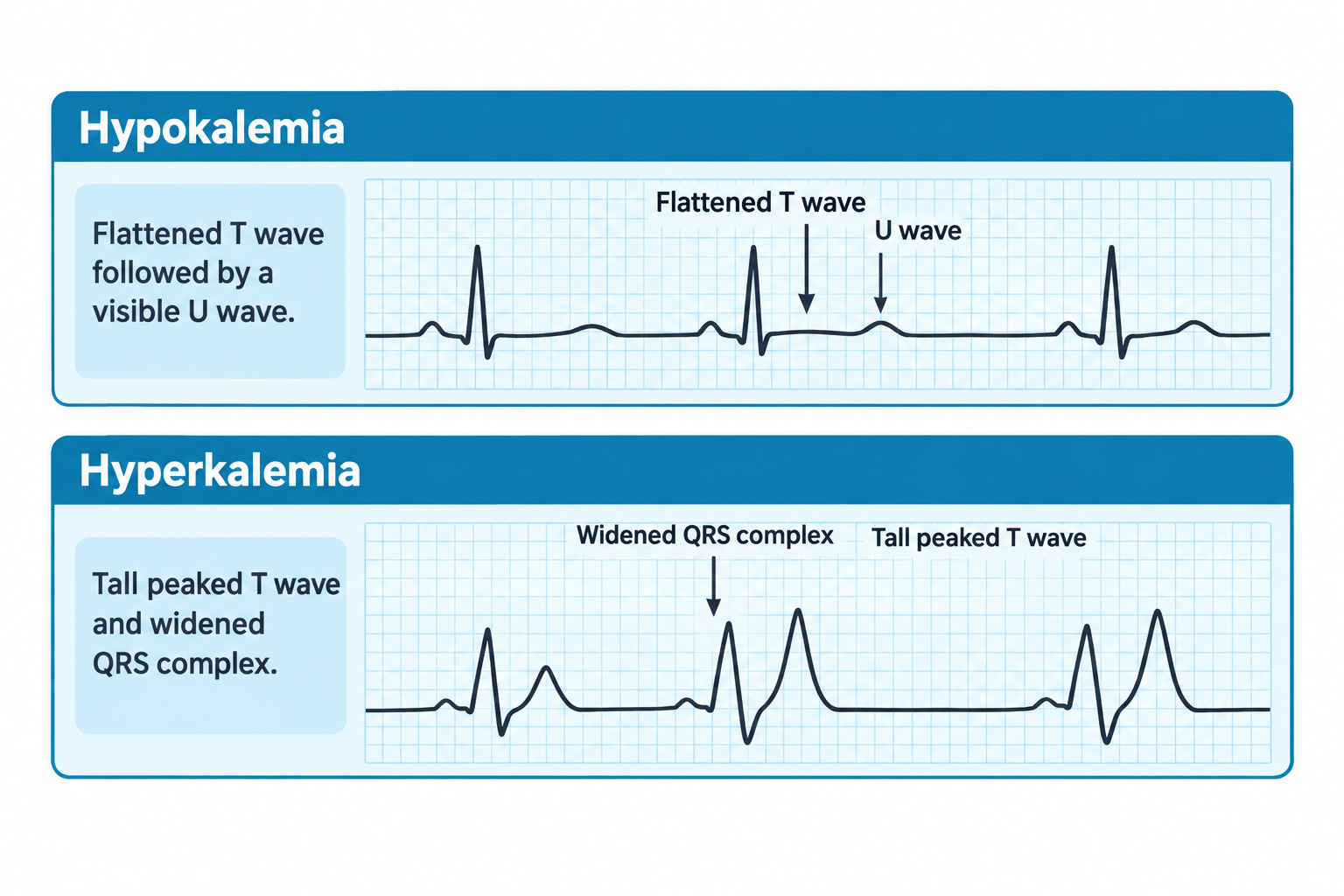 Two labeled ECG strips compare potassium imbalances: the top strip for hypokalemia shows a flattened T wave followed by a visible U wave after each QRS complex; the bottom strip for hyperkalemia shows widened QRS complexes followed by tall, peaked T waves.