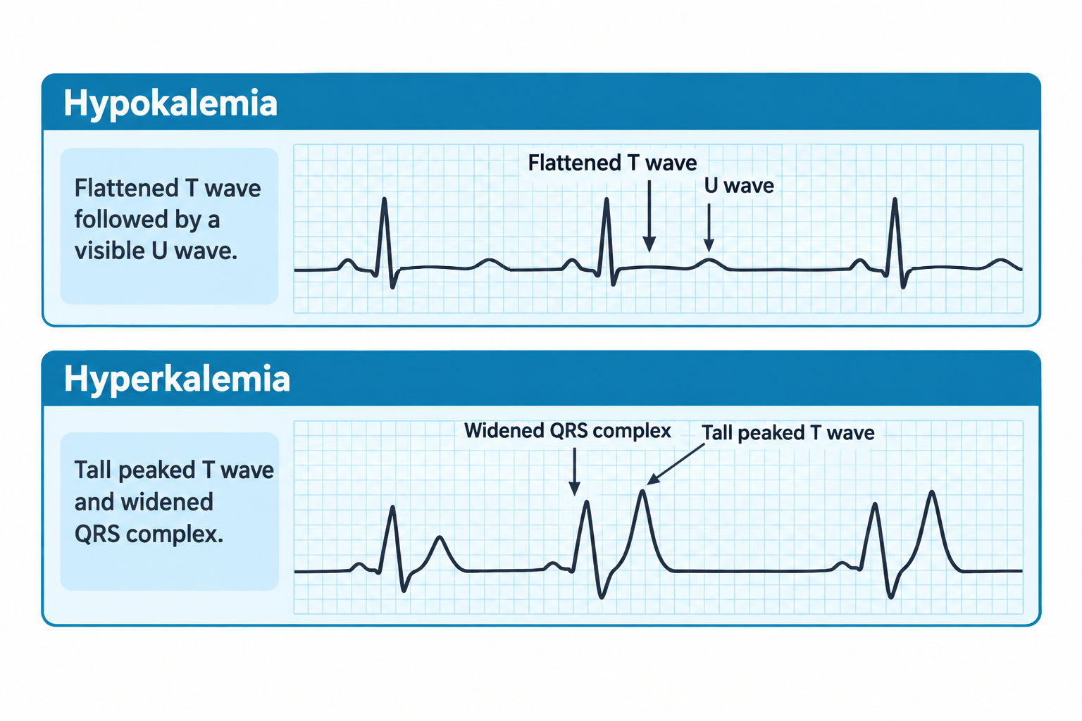 Two ECG strips comparing potassium imbalances. The top strip, labeled hypokalemia, shows a flattened T wave followed by a small visible U wave after each QRS complex. The bottom strip, labeled hyperkalemia, shows widened QRS complexes followed by tall, peaked T waves.