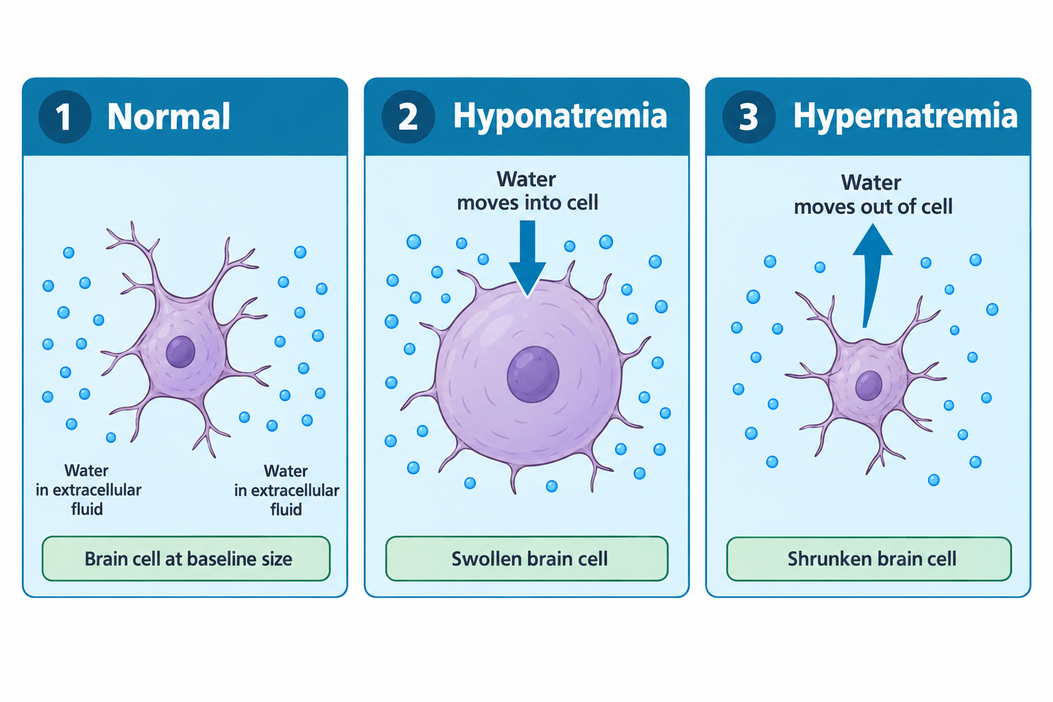 Three-panel diagram comparing brain cell size under different sodium conditions. Panel 1 shows a normal brain cell with balanced water dots in the extracellular fluid on both sides, labeled 'Brain cell at baseline size.' Panel 2 shows hyponatremia, with an arrow indicating water moves into the cell, resulting in a swollen, rounded brain cell. Panel 3 shows hypernatremia, with an arrow indicating water moves out of the cell, resulting in a shrunken brain cell with reduced volume.