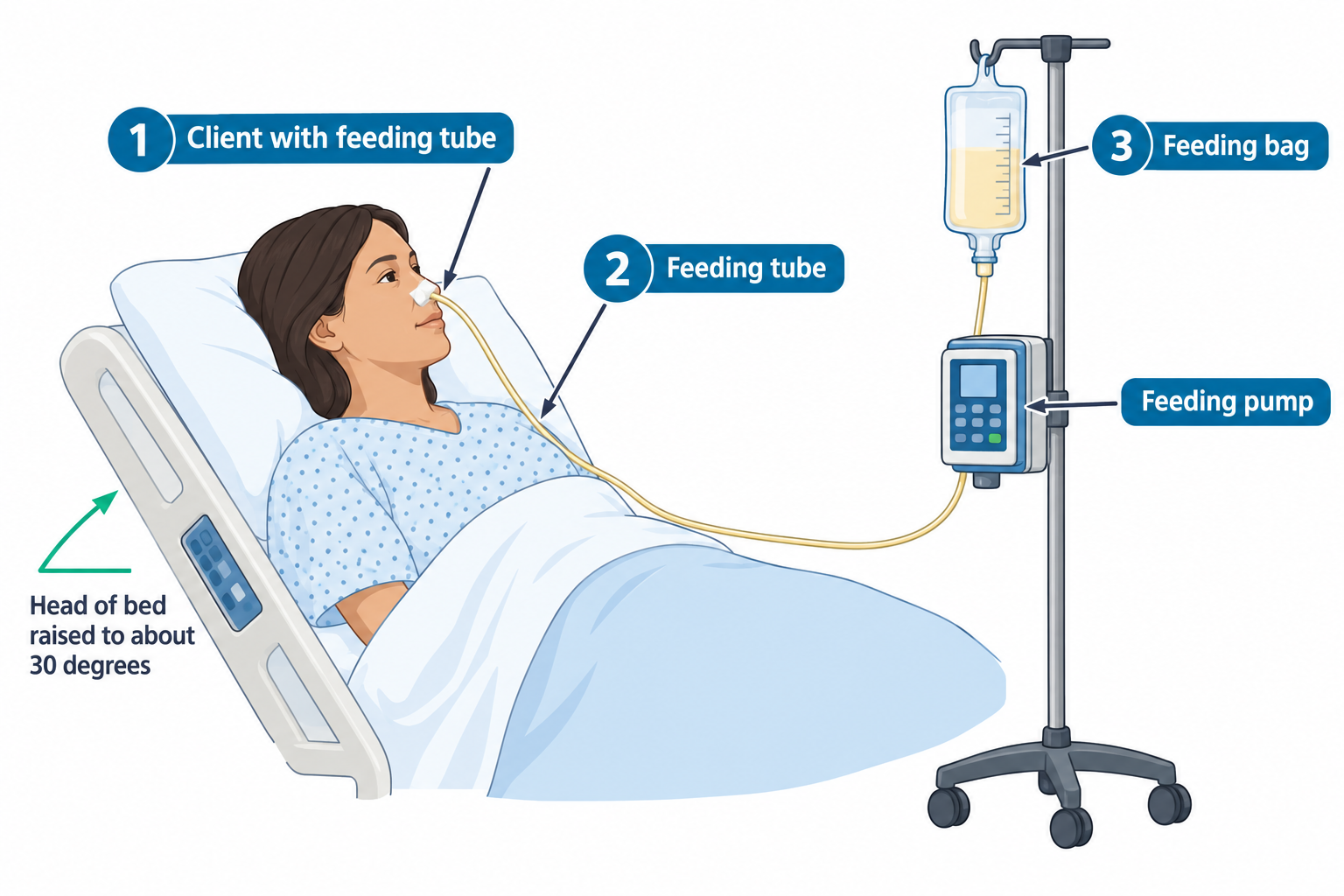 A client lies in a hospital bed with the head of the bed raised to about 30 degrees, indicated by a green angle marker. A nasoenteric feeding tube runs from the client's nose to a feeding pump mounted on an IV pole, which is connected to a feeding bag containing yellow-tinted formula above it.