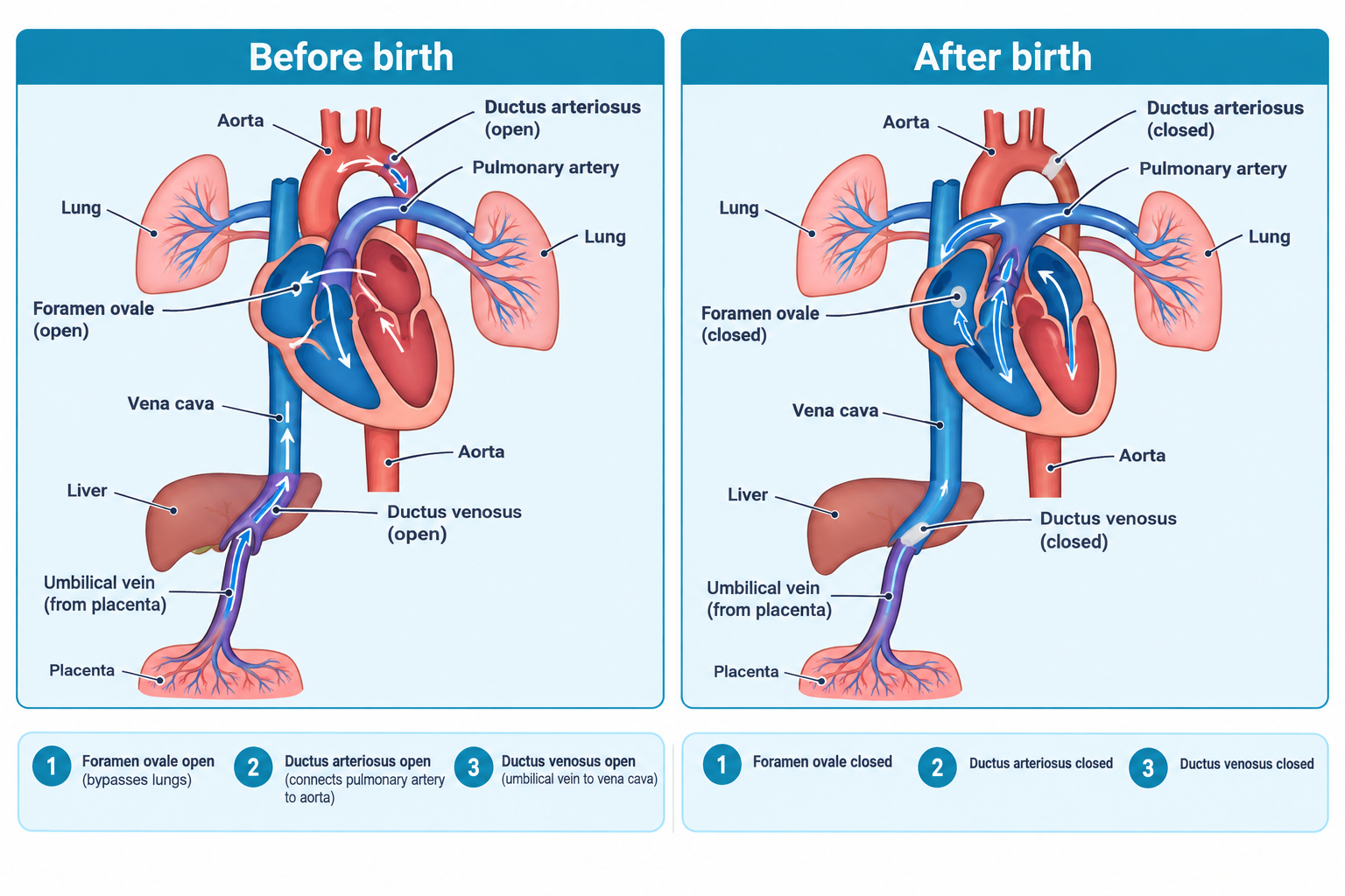 Two side-by-side heart and circulation diagrams comparing fetal and newborn circulation. The left panel, labeled Before birth, shows the foramen ovale, ductus arteriosus, and ductus venosus all open, with arrows showing blood bypassing the lungs and liver via these shunts, and umbilical vessels connecting to the placenta. The right panel, labeled After birth, shows the same three structures now closed, with blood flow arrows directed through the lungs and heart in the normal postnatal pattern, and the umbilical vessels and placenta no longer functional.