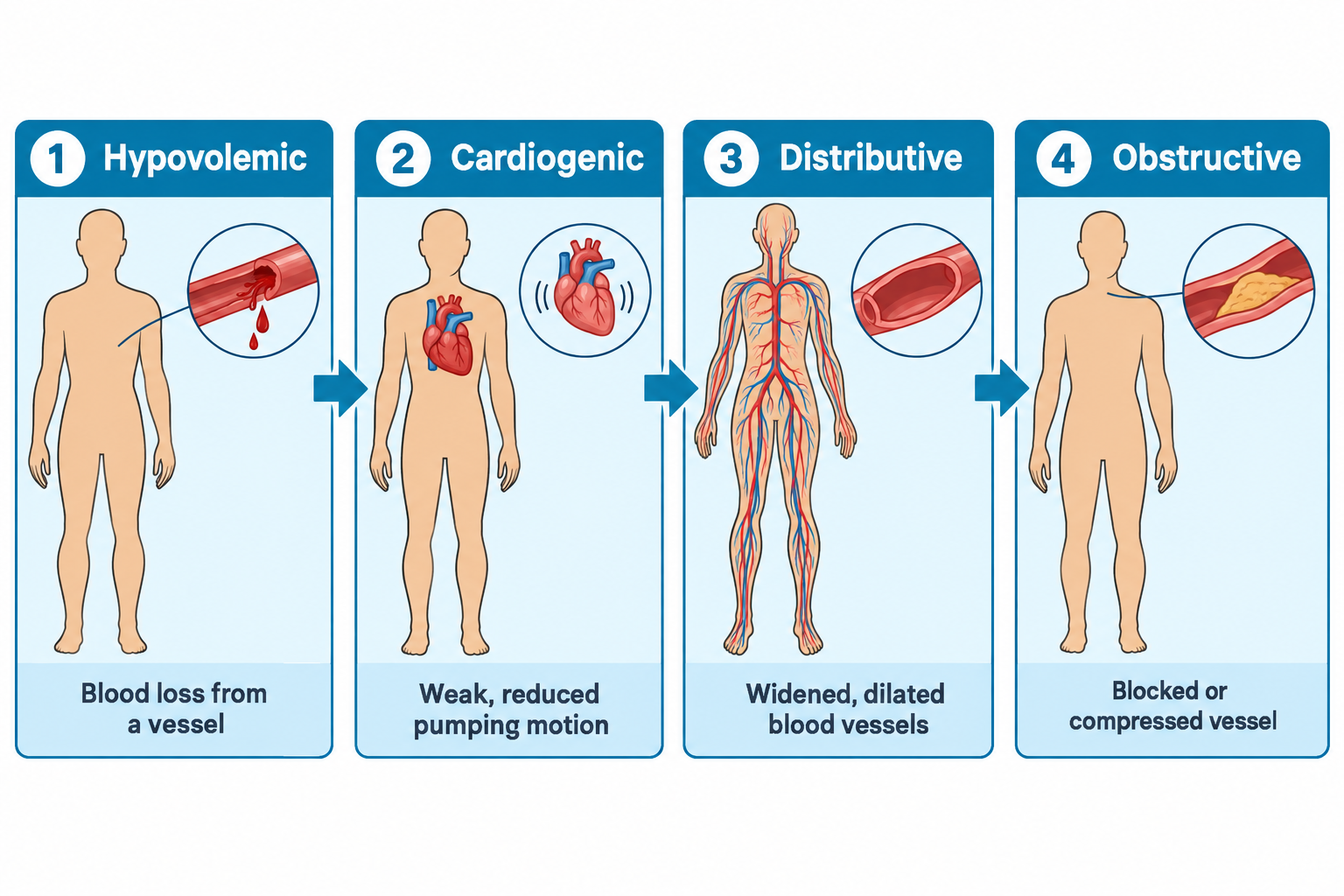 A four-panel diagram illustrating the four types of shock: Panel 1, Hypovolemic, shows a body with a close-up of a bleeding blood vessel, labeled 'Blood loss from a vessel'; Panel 2, Cardiogenic, shows a body with a close-up of a heart with motion lines, labeled 'Weak, reduced pumping motion'; Panel 3, Distributive, shows a body with a network of widened red and blue vessels and a close-up of a dilated vessel cross-section, labeled 'Widened, dilated blood vessels'; Panel 4, Obstructive, shows a body with a close-up of a vessel narrowed by a blockage, labeled 'Blocked or compressed vessel'.