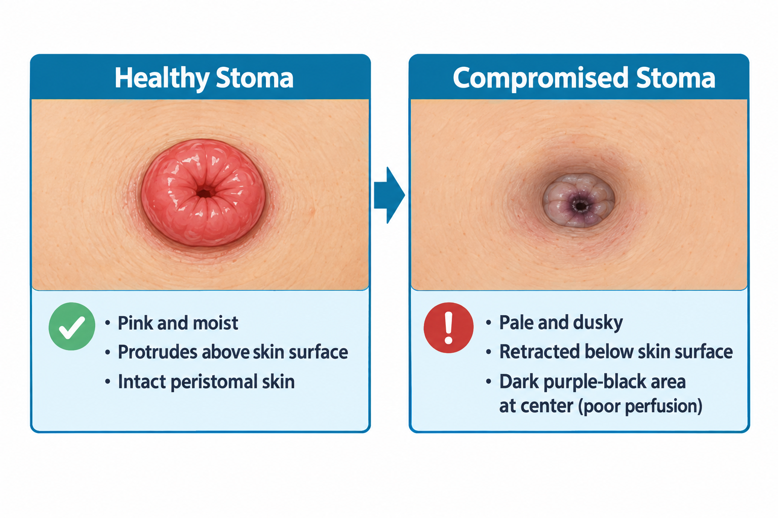 Side-by-side comparison of two stomas on abdominal skin. The healthy stoma is bright pink, moist, and protrudes above the skin with intact surrounding skin, labeled with a green check and bullets: pink and moist, protrudes above skin surface, intact peristomal skin. The compromised stoma appears pale and dusky with a dark purple-black center and sits retracted below the skin surface, labeled with a red exclamation icon and bullets: pale and dusky, retracted below skin surface, dark purple-black area at center indicating poor perfusion.