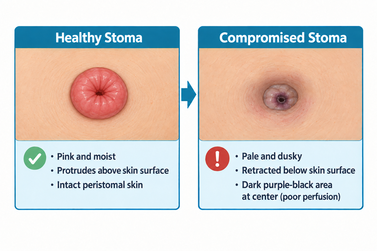 Side-by-side close-up comparison of two abdominal stomas: on the left, a healthy stoma appears bright pink/red, moist, and protrudes above the surrounding skin with intact peristomal skin, marked with a green checkmark; on the right, a compromised stoma appears pale and dusky, sits retracted below the skin surface, and has a dark purple-black center indicating poor perfusion, marked with a red warning icon.