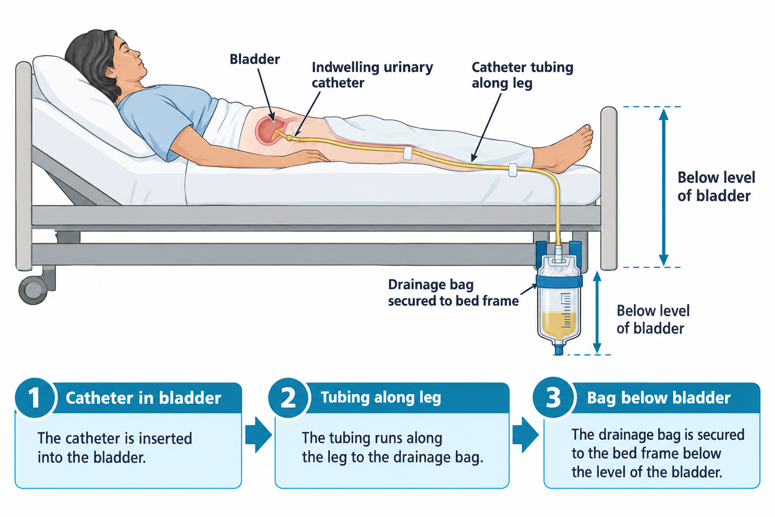 A patient lies supine in a hospital bed with an indwelling urinary catheter inserted into the bladder; the catheter tubing is labeled as it runs along the leg, secured with tubing clips, down to a drainage bag that is fastened to the bed frame below the level of the bladder, with vertical arrows indicating the bag's position below bladder height. Three numbered steps below summarize: 1) catheter in bladder, 2) tubing along leg, 3) bag below bladder.