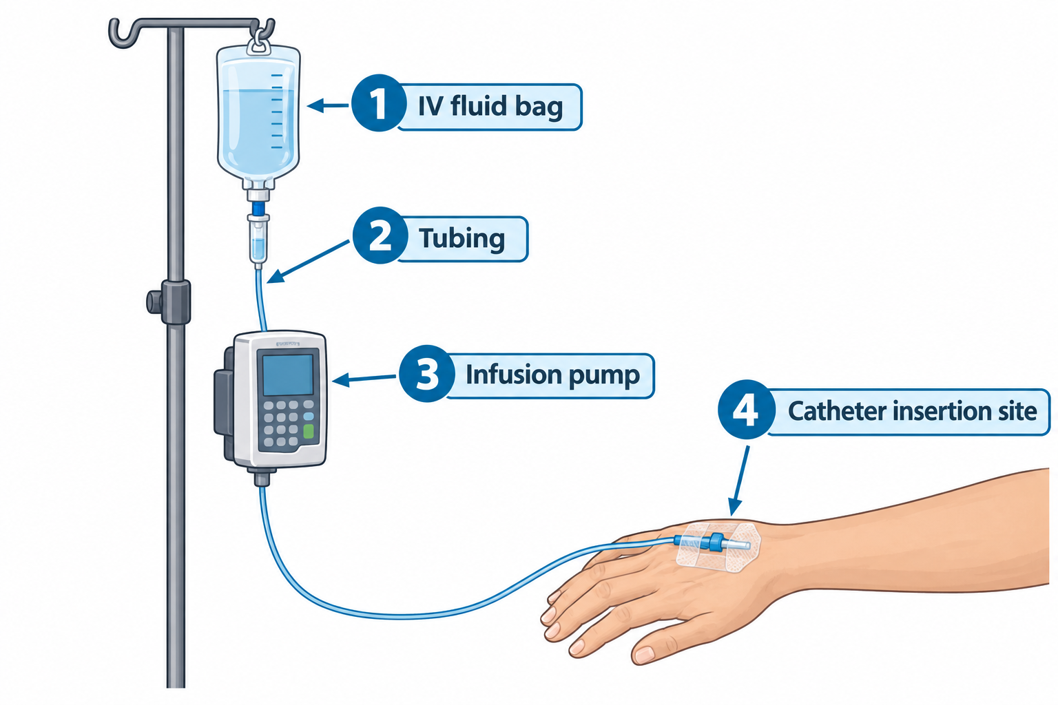 An IV pole holds a fluid bag (labeled 1) connected by tubing (labeled 2) down to an infusion pump (labeled 3), with tubing continuing from the pump to a catheter inserted into the back of a patient's hand, secured with a transparent dressing (labeled 4, catheter insertion site).