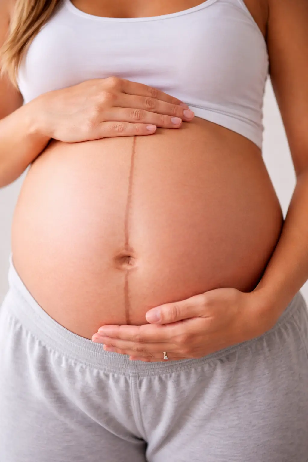 Hyperpigmentation ontop of linea alba characteristic of pregnancy
