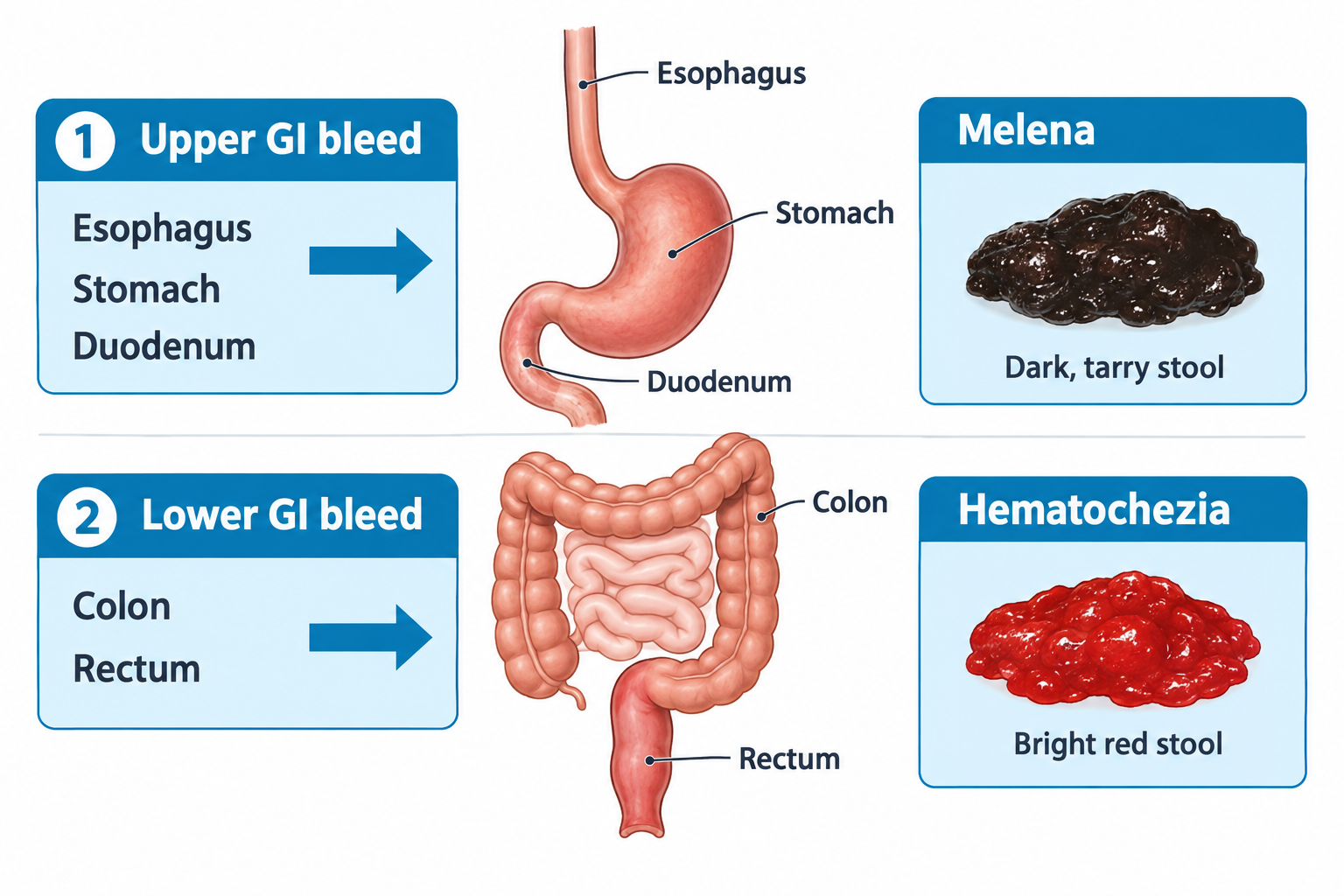 Two-panel diagram comparing GI bleed locations and stool appearance. Top: an upper GI tract illustration with esophagus, stomach, and duodenum labeled, linked to a panel showing melena as dark, tarry stool. Bottom: a lower GI tract illustration with colon and rectum labeled, linked to a panel showing hematochezia as bright red stool.