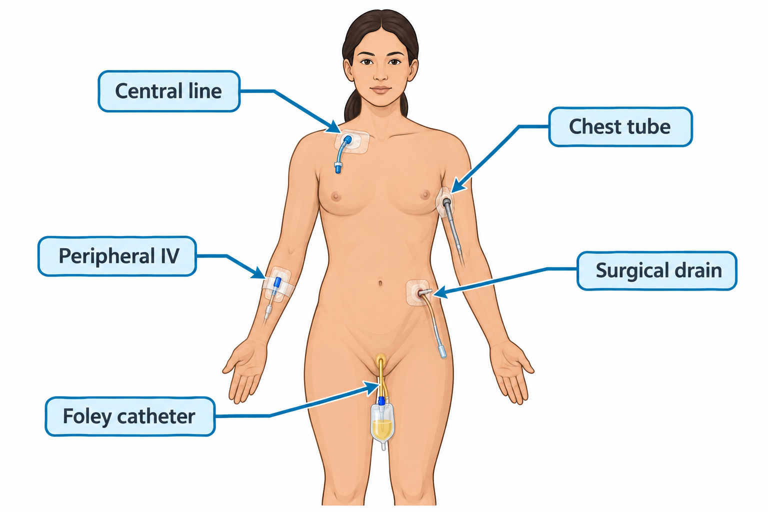 Front view of an unclothed adult female figure with five invasive devices labeled and indicated by arrows: a central line dressing at the base of the neck near the clavicle, a peripheral IV in the forearm, a chest tube inserted at the lateral chest/axillary region with tubing running down the arm, a surgical drain exiting the lower abdomen, and a Foley catheter with attached urine drainage bag at the groin.
