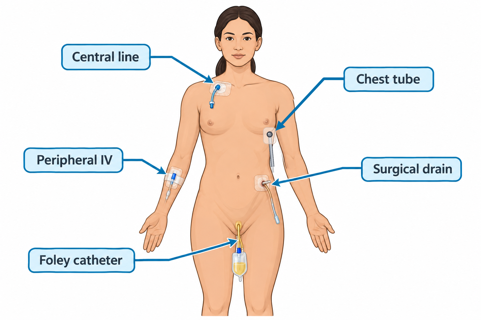 Front view of an unclothed adult female figure with five invasive devices indicated by arrows: a central line dressing near the base of the neck/clavicle, a peripheral IV in the forearm, a chest tube entering the lateral chest with tubing running down the arm, a surgical drain exiting the lower abdomen, and a Foley catheter with a urine drainage bag at the groin.